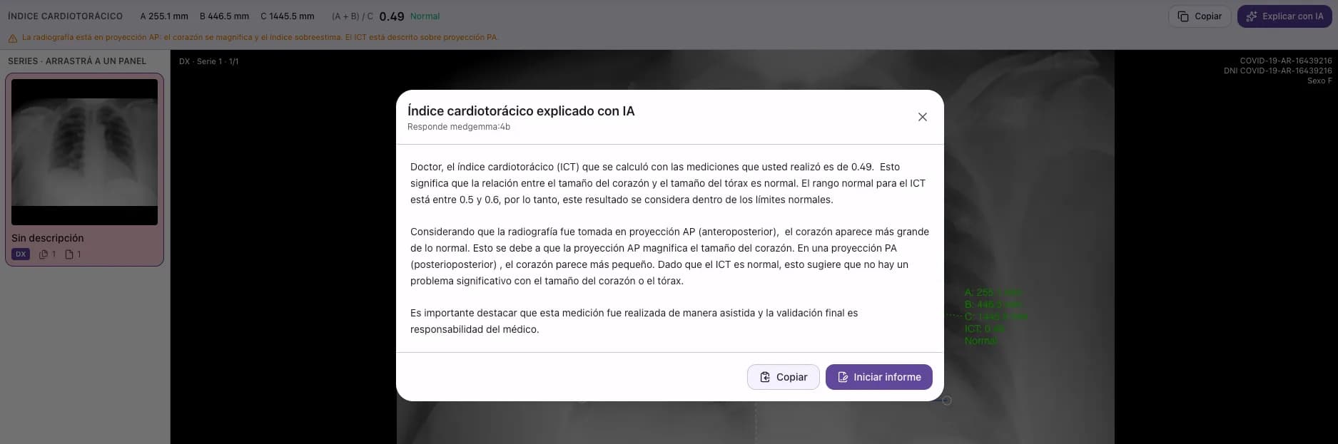 Diálogo Índice cardiotorácico explicado con IA, con la interpretación del valor 0.49, el efecto de la proyección AP, la aclaración de que la validación es del médico y los botones Copiar e Iniciar informe.