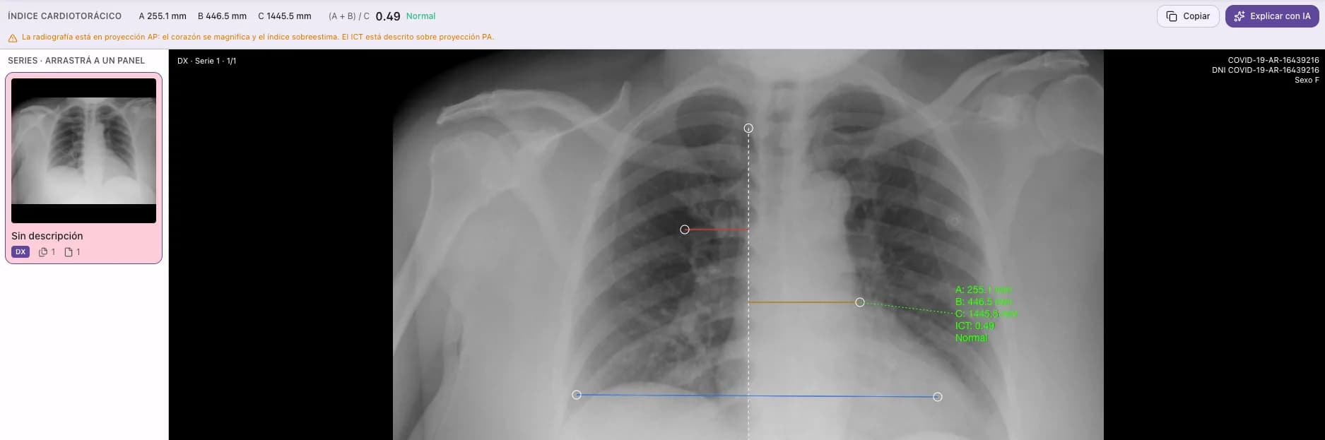 Herramienta de índice cardiotorácico sobre una radiografía de tórax: las medidas A, B y C marcadas, el índice 0.49 clasificado como normal, el aviso de proyección AP y el botón Explicar con IA.